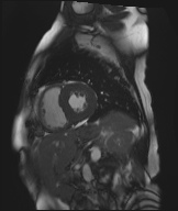 Cardiac amyloidosis (Radiopaedia 51404-57150 Sagittal CINE SSFP 181).jpg