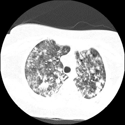 File:Cardiac angiosarcoma (Radiopaedia 66010-75181 Axial lung window 70).jpg