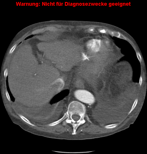 File:Cardiac perforation following transcatheter aortic valve implantation (Radiopaedia 23714-23863 A 17).png