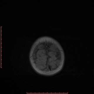 File:Cardiac rhabdomyoma - tuberous sclerosis (Radiopaedia 70089-80114 Axial T1 19).jpg