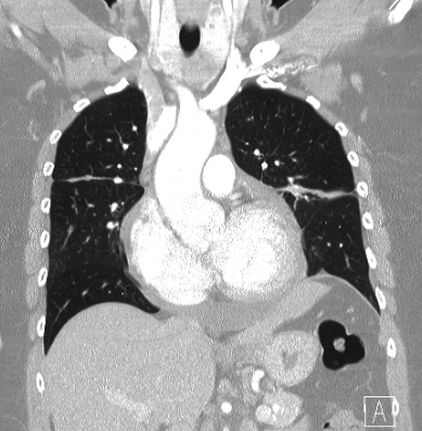 Cardiac sarcoidosis (Radiopaedia 74548-85534 Coronal lung window 26).jpg