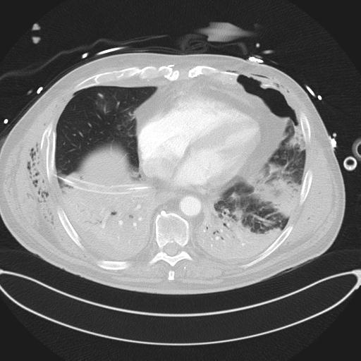 Cardiac trauma (Radiopaedia 32874-33858 Axial lung window 38).jpg