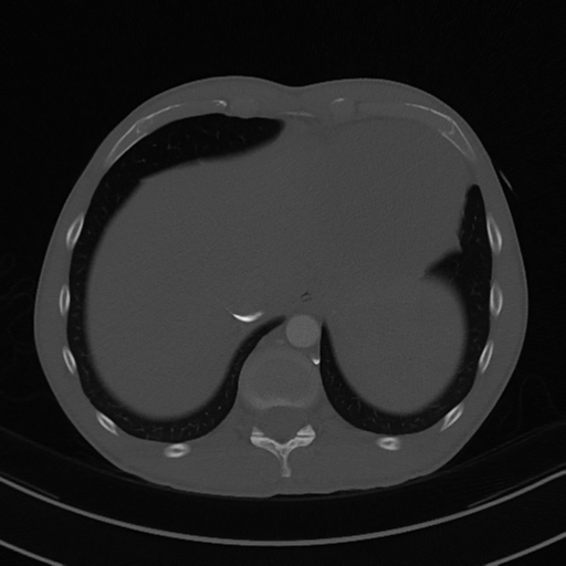File:Cardiac tumor - undifferentiated pleomorphic sarcoma (Radiopaedia 45844-50134 Axial bone window 59).png