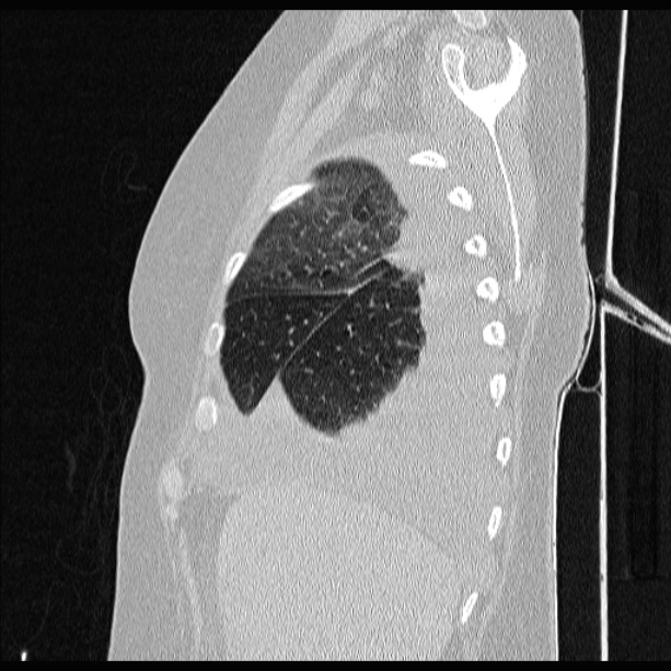 Cardiogenic pulmonary edema (Radiopaedia 29213-29609 Sagittal lung window 18).jpg