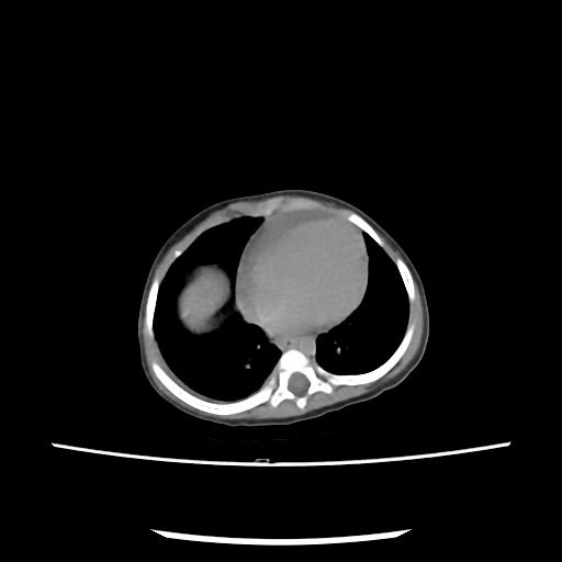 Caroli disease with autosomal recessive polycystic kidney disease (ARPKD) (Radiopaedia 89651-106703 E 6).jpg