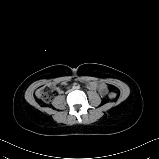 Caroli disease with medullary sponge kidney (Radiopaedia 82622-96804 C 44).jpg