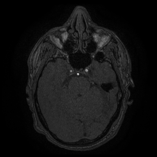 Carotid arterial dissection with acute cerebral infarction (Radiopaedia 26636-26784 MRA 118).jpg