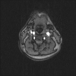 Carotid artery dissection (Radiopaedia 28441-28689 Axial MRA 39).jpg