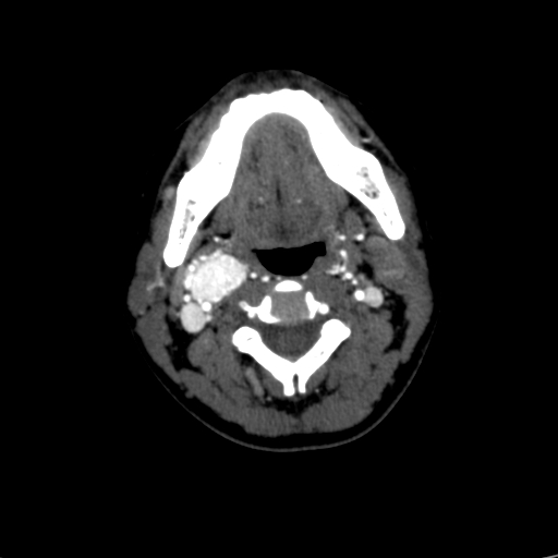 File:Carotid body tumor (Radiopaedia 39845-42300 B 45).jpg