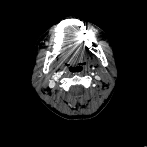 File:Carotid body tumor (Radiopaedia 39845-42300 B 53).jpg