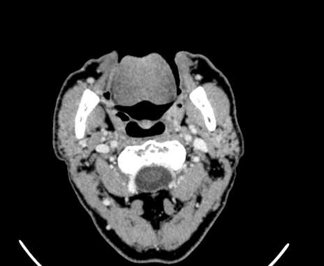 Carotid body tumor (Radiopaedia 61750-69757 Axial Post contrast 22).jpg