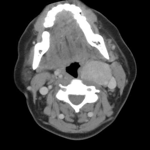 Carotid body tumor (paraganglioma) (Radiopaedia 38586-40729 A 16).jpg