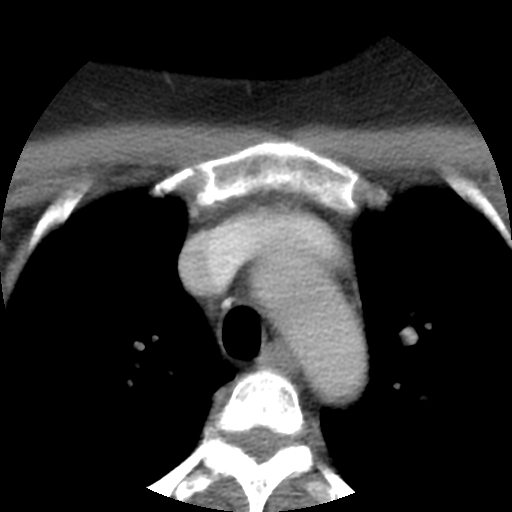 Carotid body tumor (paraganglioma) (Radiopaedia 38586-40729 A 35).jpg
