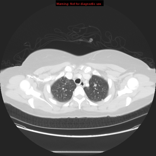Carotid body tumor with lung metastases (Radiopaedia 9301-48390 Axial lung window 18).jpg