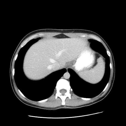 File:Castleman disease with fibrous pseudotumor in the abdomen (Radiopaedia 77296-89373 Axial 109).jpg