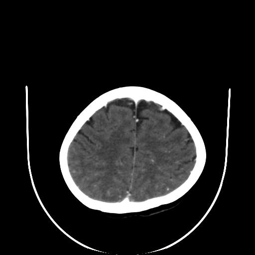 File:Cavernoma with developmental venous anomaly (Radiopaedia 22470-22506 C+ arterial phase 28).jpg