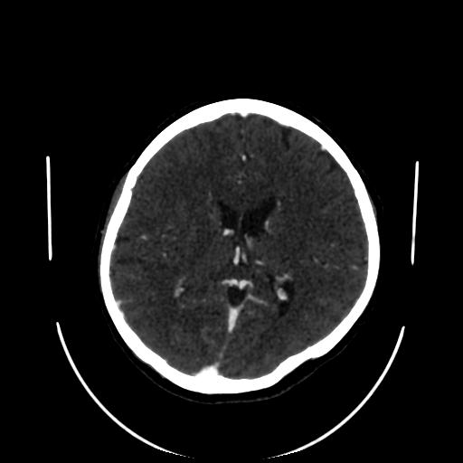 Cavernoma with developmental venous anomaly (Radiopaedia 22470-22506 C 101).jpg