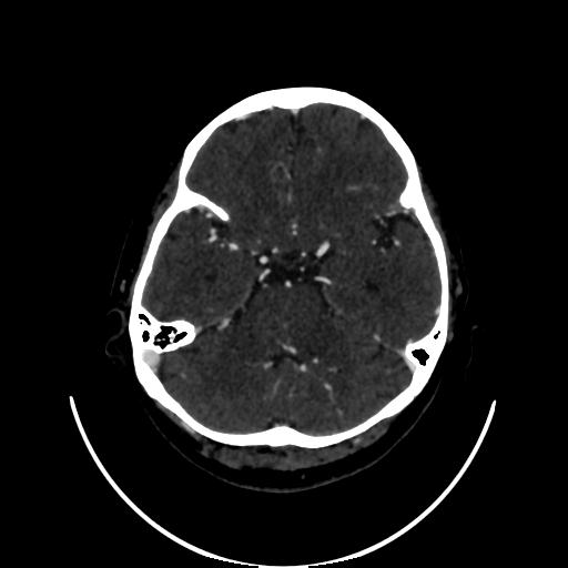 Cavernoma with developmental venous anomaly (Radiopaedia 22470-22506 C 46).jpg