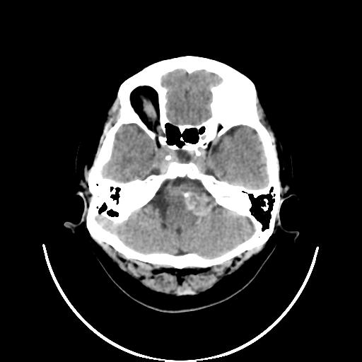 File:Cavernoma with developmental venous anomaly (Radiopaedia 22470-22506 non-contrast 7).jpg