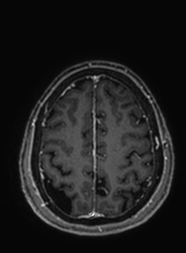 Cavernous hemangioma of the cerebellar falx (Radiopaedia 73025-83724 Axial T1 C+ 81).jpg