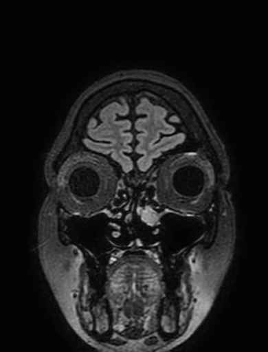 Cavernous hemangioma of the cerebellar falx (Radiopaedia 73025-83724 Coronal FLAIR 32).jpg