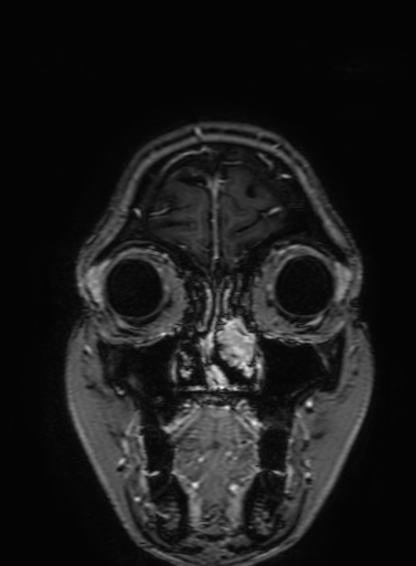 Cavernous hemangioma of the cerebellar falx (Radiopaedia 73025-83724 Coronal T1 C+ 41).jpg