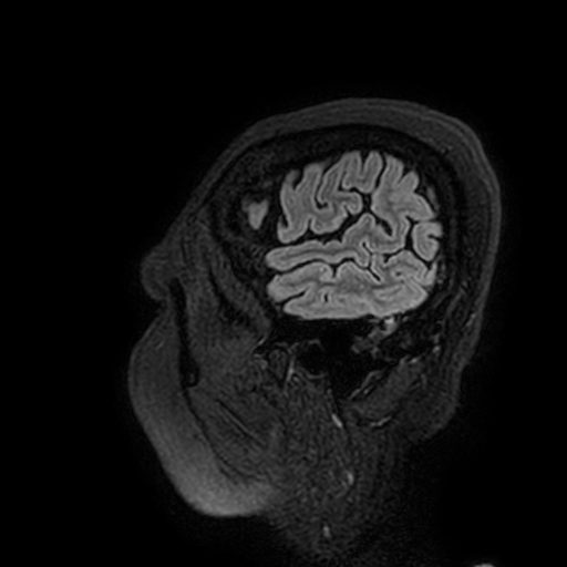 File:Cavernous hemangioma of the cerebellar falx (Radiopaedia 73025-83724 Sagittal FLAIR 201).jpg