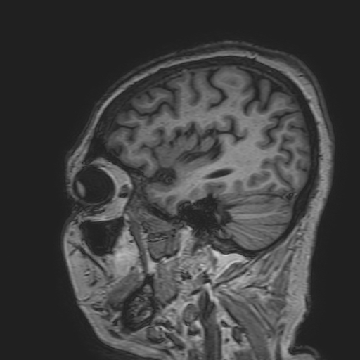 File:Cavernous hemangioma of the cerebellar falx (Radiopaedia 73025-83724 Sagittal T1 51).jpg
