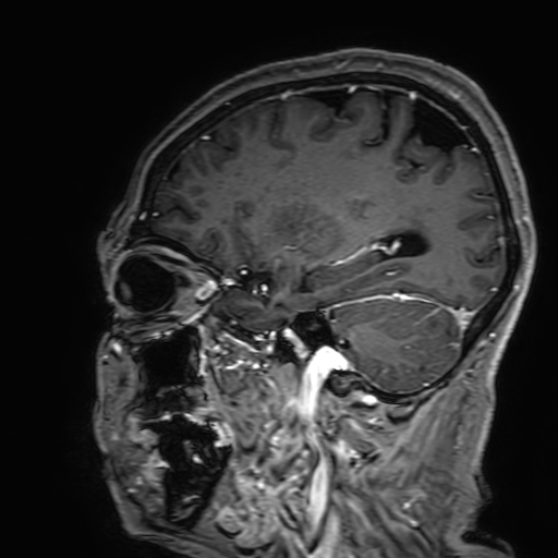 Cavernous hemangioma of the cerebellar falx (Radiopaedia 73025-83724 Sagittal T1 C+ 150).jpg