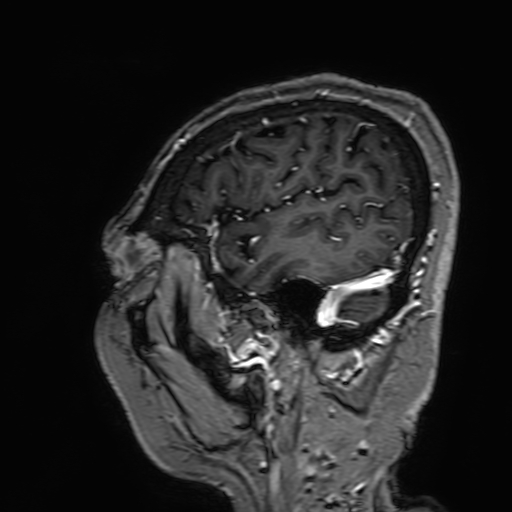 Cavernous hemangioma of the cerebellar falx (Radiopaedia 73025-83724 Sagittal T1 C+ 34).jpg