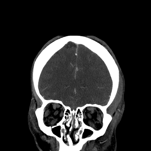 File:Cavernous sinus thrombosis (Radiopaedia 10619-11078 D 4).jpg