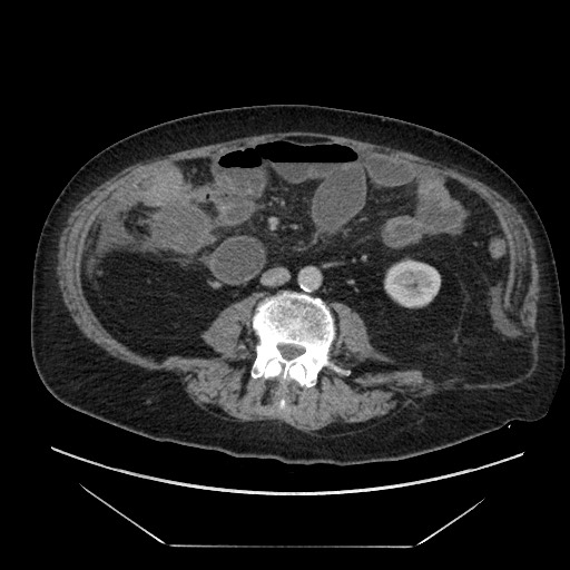 Cecal adenocarcinoma (Radiopaedia 64871-73817 A 54).jpg