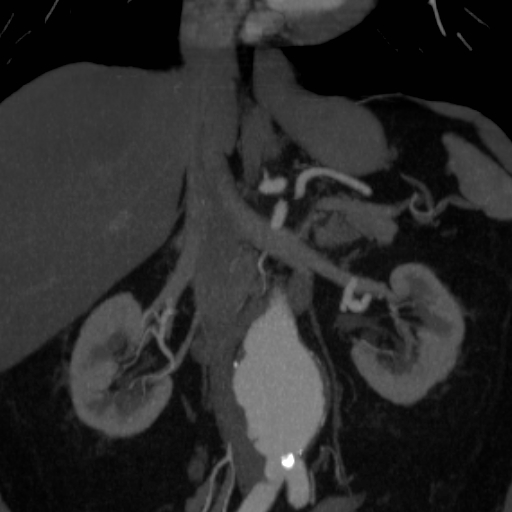 File:Celiac artery compression by the diaphragmatic crurae (Radiopaedia 31739-32666 B 5).jpg