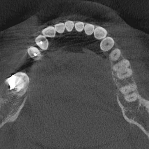 Cemento-osseous dysplasia (Radiopaedia 48251-53126 Axial non-contrast 54).jpg