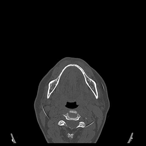 File:Cemento-ossifying fibroma (Radiopaedia 21243-21149 Axial bone window 12).jpg