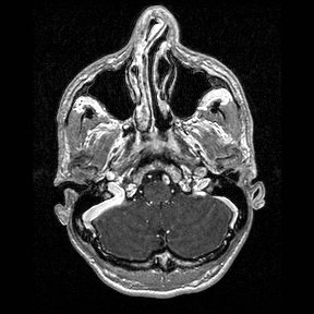 Central-variant posterior reversible encephalopathy syndrome (PRES) (Radiopaedia 43880-47358 Axial T1 C+ 16).jpg