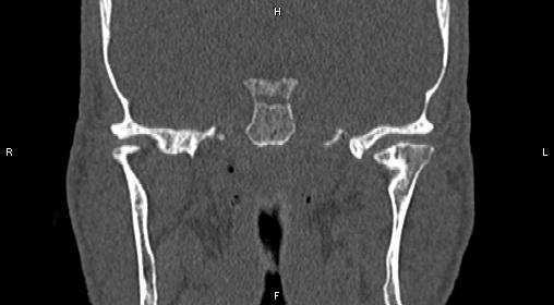 File:Central giant cell granuloma (Radiopaedia 83346-97761 Coronal bone window 28).jpg