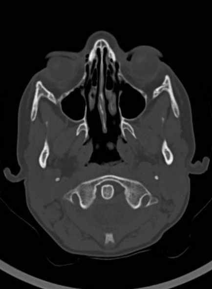 Cerebellar abscess (Radiopaedia 73727-84527 Axial bone window 16).jpg