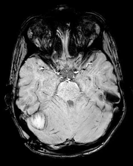 Cerebellar abscess (Radiopaedia 73727-84563 Axial SWI 25).jpg