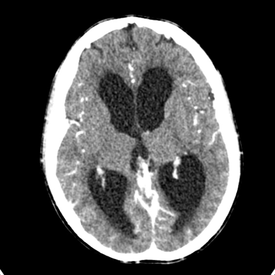 Cerebellar abscess secondary to mastoiditis (Radiopaedia 26284-26412 Axial C+ delayed 79).jpg