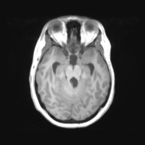 File:Cerebellar ependymoma complicated by post-operative subdural hematoma (Radiopaedia 83322-97736 Axial T1 17).png