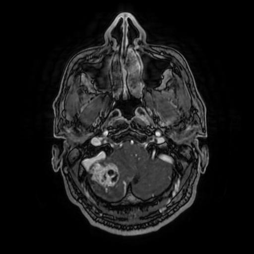 File:Cerebellar hemangioblastoma (Radiopaedia 88055-104622 Axial T1 C+ 37).jpg