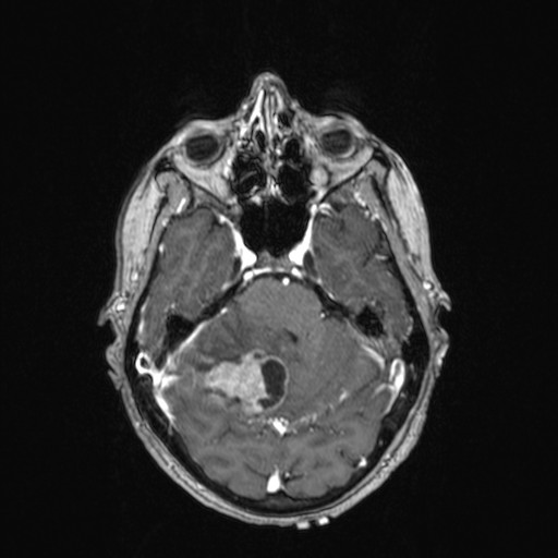 Cerebellar metastases (Radiopaedia 24038-24249 Axial T1 C+ 32).jpg