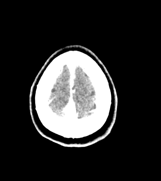 Cerebellar metastases - colorectal adenocarcinoma (Radiopaedia 40947-43652 Axial C+ 60).png