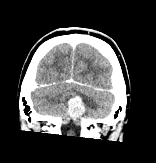 Cerebellar metastases - colorectal adenocarcinoma (Radiopaedia 40947-43652 Coronal C+ 76).png