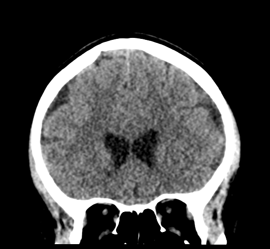 Cerebellar metastases - colorectal adenocarcinoma (Radiopaedia 40947-43652 Coronal non-contrast 33).png