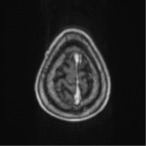 Cerebellar metastasis from lung adenocarcinoma (Radiopaedia 86690-102829 Axial T1 C+ 73).png