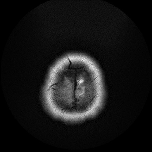File:Cerebellar metastasis of pulmonary adenocarcinoma, cavernous venous malformation, and developmental venous anomaly (Radiopaedia 85827-101661 Axial T2 31).jpg