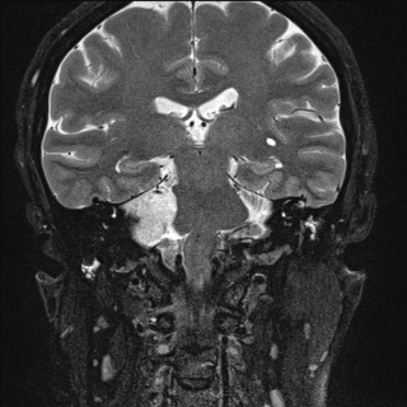 File:Cerebellopontine angle meningioma (Radiopaedia 53561-59591 Coronal T2 14).jpg