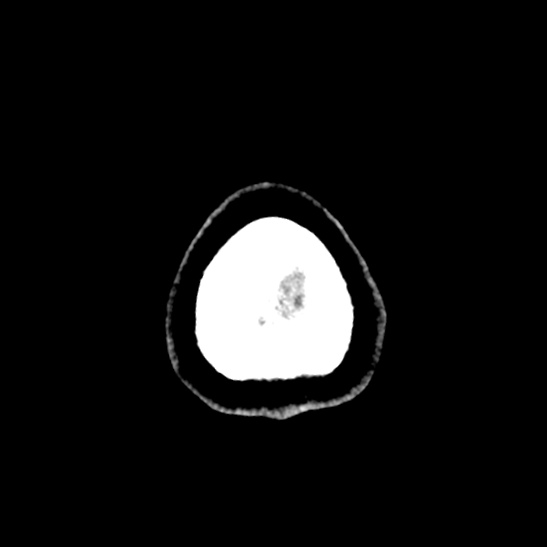 Cerebellopontine angle meningioma (Radiopaedia 53561-59592 Axial non-contrast 69).jpg